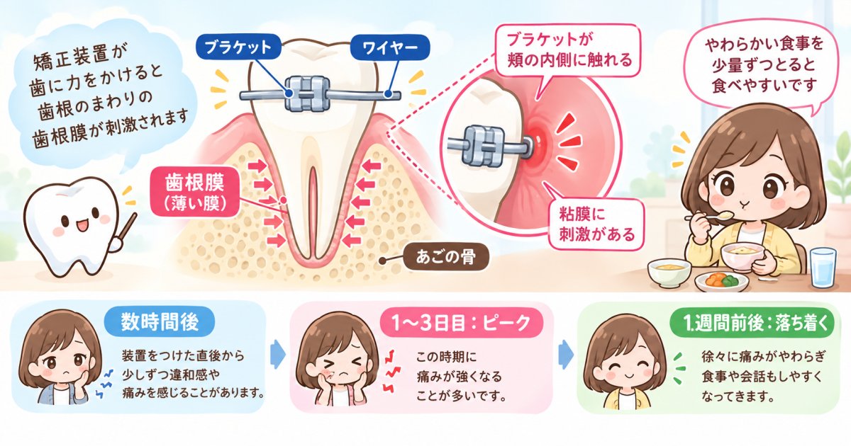 大人の矯正で起こる痛みの仕組みと、ピークから落ち着くまでの期間を解説